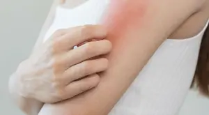 Client experienced an allergic reaction from a procedure.